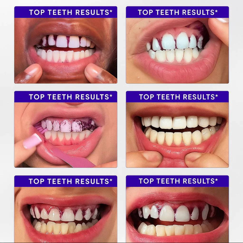 🔥 Limited-Time Deal: Purple Teeth Whitening Strips