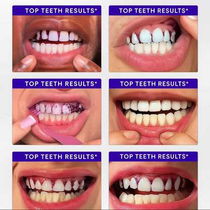 🔥 Limited-Time Deal: Purple Teeth Whitening Strips